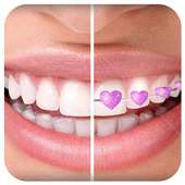 Braces App that look Real for Boys & Girls on 9Apps