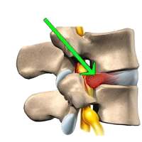 Herniated Disc Exercises on 9Apps
