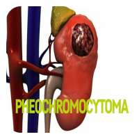 Pheochromocytoma