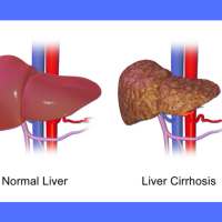 Liver Cirrhosis