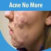 Acne No More