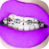 Braces on Photo Editor - Real Braces Teeth Pro on 9Apps