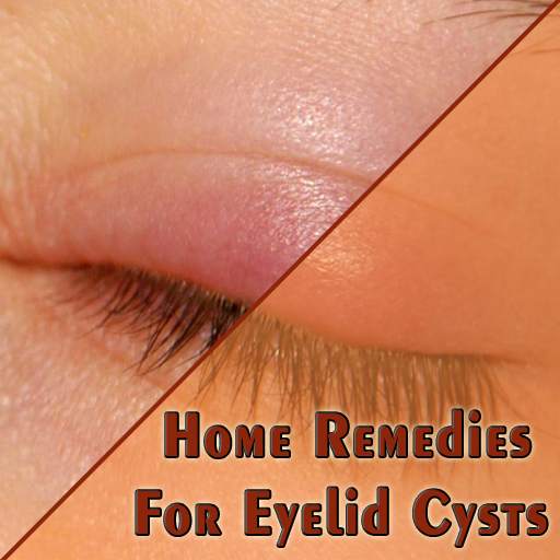 Home Remedies For Eyelid Cysts (Chalazion)