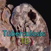 Tuberculosis TB on 9Apps