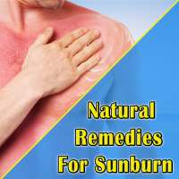 Natural Remedies For Sunburn on 9Apps