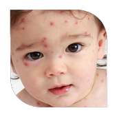 Chickenpox in children on 9Apps