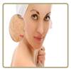 Acne & Pimples (Home Care)
