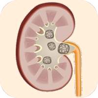 Kidney Stone Symptoms & Treatment