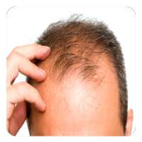 Baldness Guide