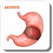 Tratar la gastritis on 9Apps