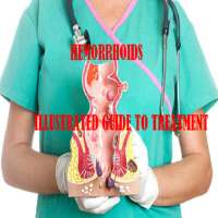 HEMORRHOIDS:Guide to Treatment