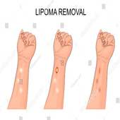 Lipoma Solution Disease on 9Apps