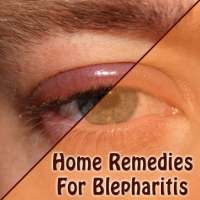 Home Remedies For Blepharitis Eyelid Inflammation on 9Apps