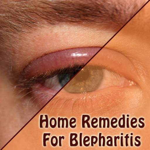 Home Remedies For Blepharitis Eyelid Inflammation