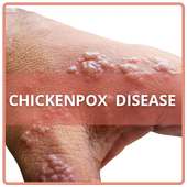 Chickenpox Disease