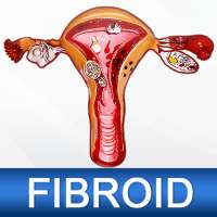 Uterine Fibroid Causes Symptoms Types & Treatment on 9Apps