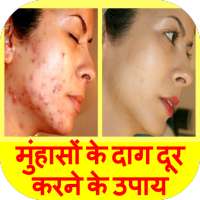 Pimple Marks Removal in Hindi