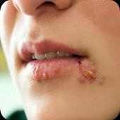 Home Remedies for Herpes on 9Apps